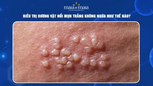 Dương vật nổi mụn trắng không ngứa