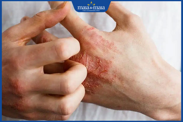 Tổng hợp các cách chữa viêm da cơ địa không nên bỏ qua 6 gãi khi viêm da