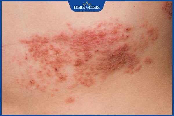 giai đoạn đau sau zona