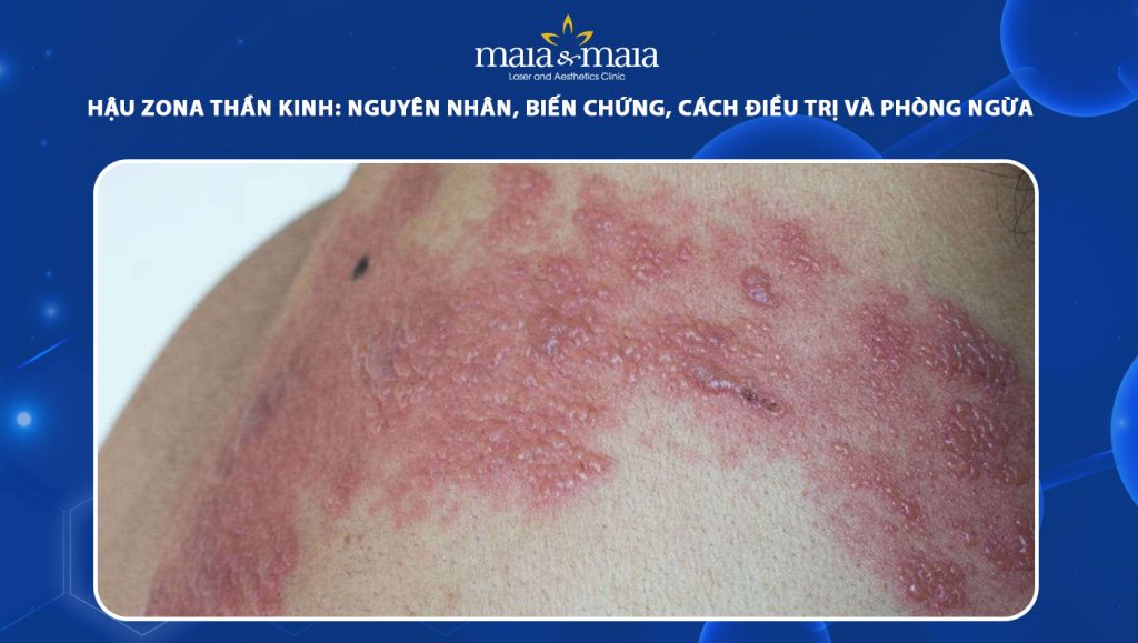 hậu zona thần kinh