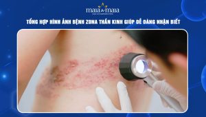 hình ảnh bệnh zona thần kinh