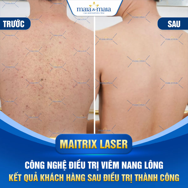 Viêm nang lông: Dấu hiệu, nguyên nhân và cách điều trị 13 hình ảnh khách điều trị viêm nang lông