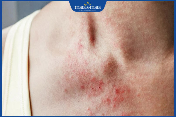 Viêm da thần kinh: Triệu chứng, nguyên nhân và cách điều trị 4 hình ảnh viêm da thần kinh