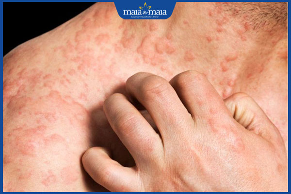 Điều trị viêm da cơ địa ở người lớn bằng công nghệ hiện đại 5 hình ảnh viêm da trên cơ thể