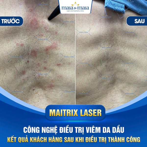 Viêm da dầu: Triệu chứng, chẩn đoán, điều trị và phòng ngừa 15 kết quả chữa viêm da dầu