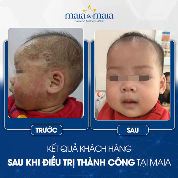 Chi tiết cách chăm sóc trẻ bị viêm da cơ địa tại nhà 8 kết quả chữa viêm da ở trẻ