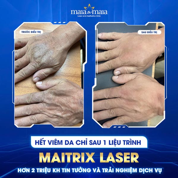 kết quả chữa viêm da