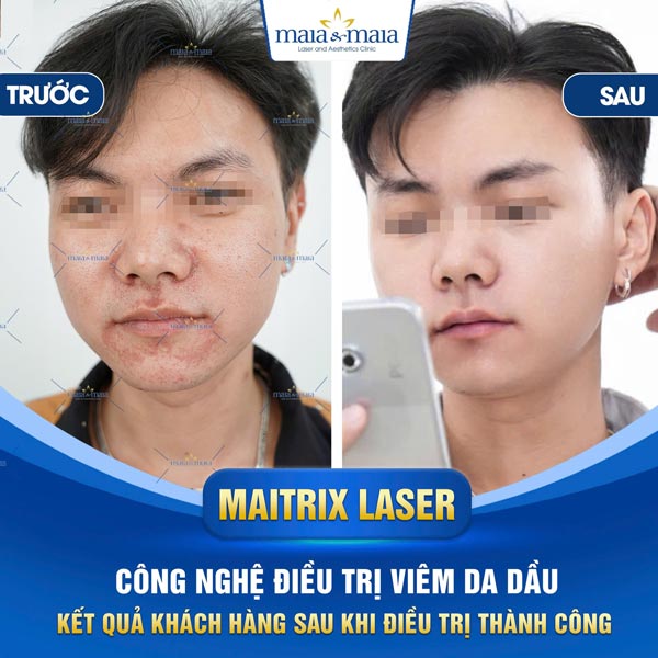 Viêm da dầu: Triệu chứng, chẩn đoán, điều trị và phòng ngừa 14 kết quả điều trị viêm da dầu