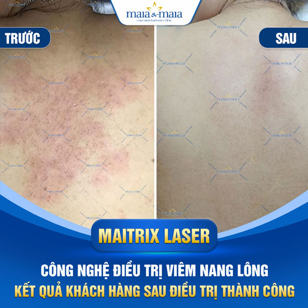 Viêm nang lông: Dấu hiệu, nguyên nhân và cách điều trị 12 kết quả khách điều trị viêm nang lông