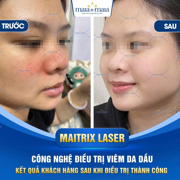 Viêm da dầu: Triệu chứng, chẩn đoán, điều trị và phòng ngừa 13 kết quả trị viêm da dầu