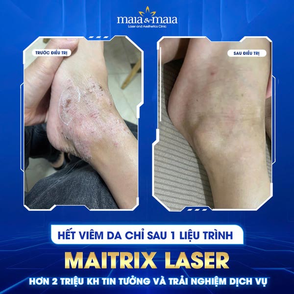 kết quả trị viêm da ở chân