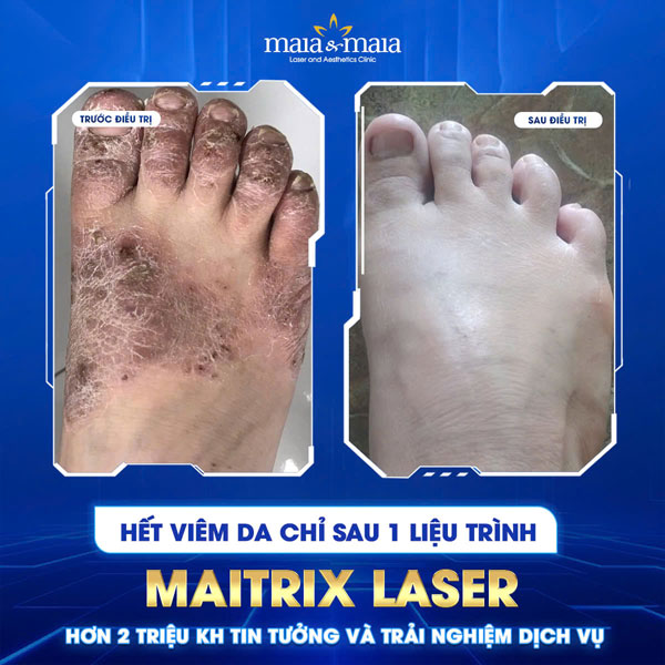 khách chữa viêm da cơ địa thành công