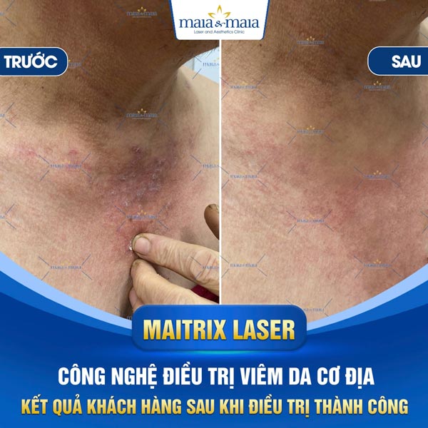 khách chữa viêm da cơ địa