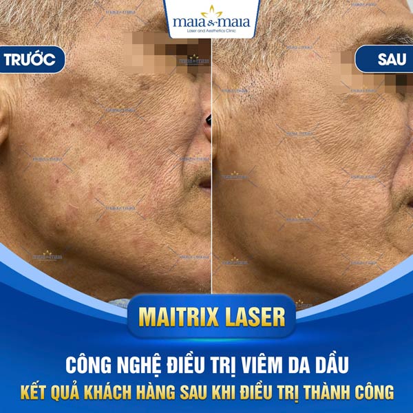 Viêm da dầu: Triệu chứng, chẩn đoán, điều trị và phòng ngừa 12 khách chữa viêm da dầu