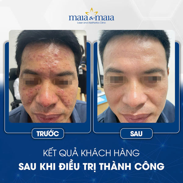 Viêm da dị ứng ở mặt có nguy hiểm không? Cách điều trị 13 khách chữa viêm da mặt