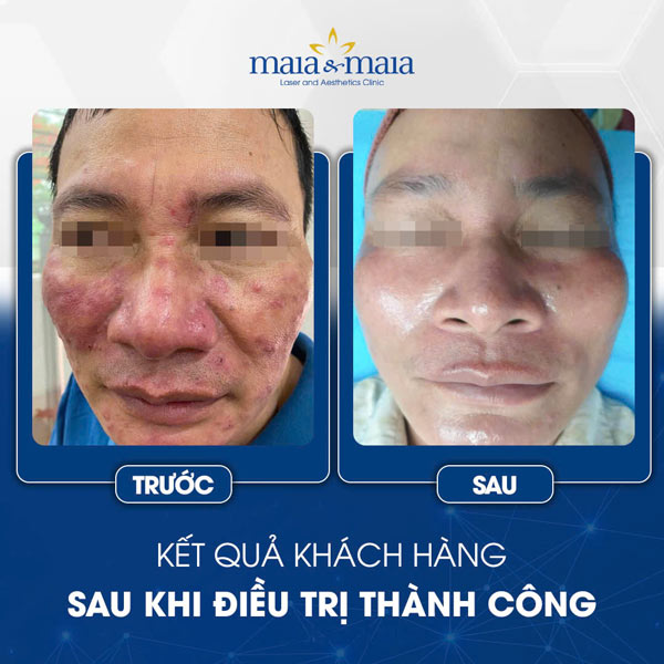 Viêm da dị ứng ở mặt có nguy hiểm không? Cách điều trị 12 khách chữa viêm da ở mặt