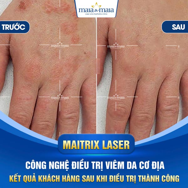 khách chữa viêm da ở tay