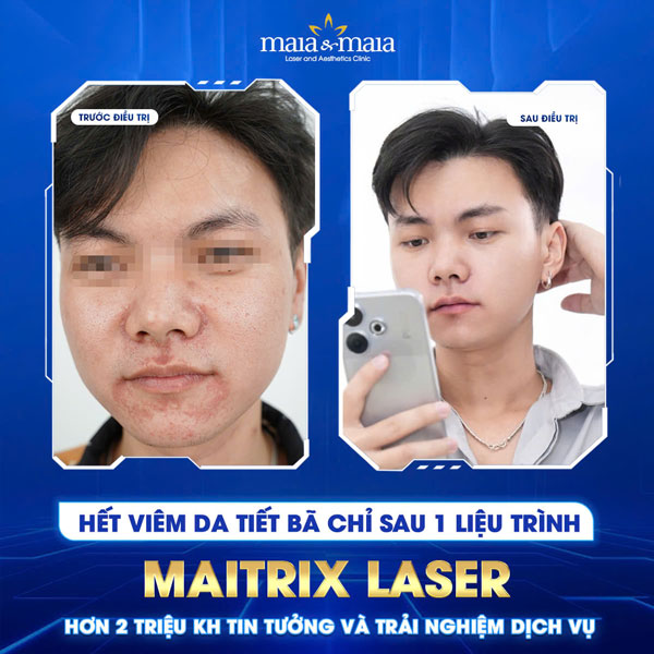 khách chữa viêm da tiêt bã tại mai