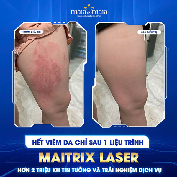 khách điều trị viêm da cơ địa