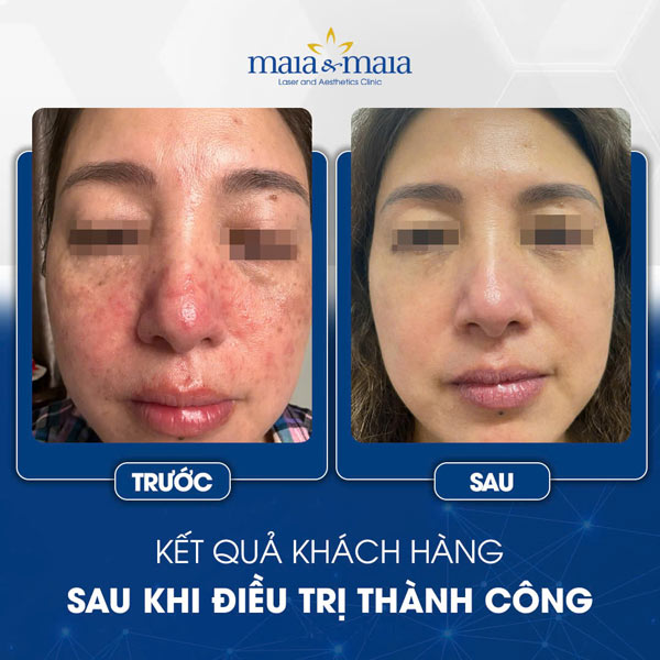 Viêm da dị ứng ở mặt có nguy hiểm không? Cách điều trị 11 khách điều trị viêm da mặt