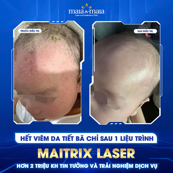 khách hàng chữa viêm da cơ địa thành công tại maia