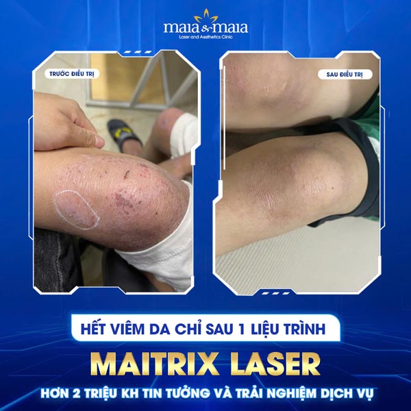 khách trị viêm da chân