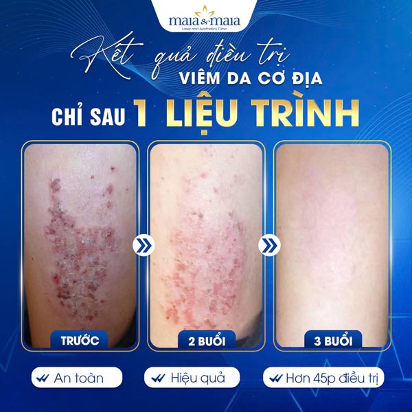 khách trị viêm da cơ địa