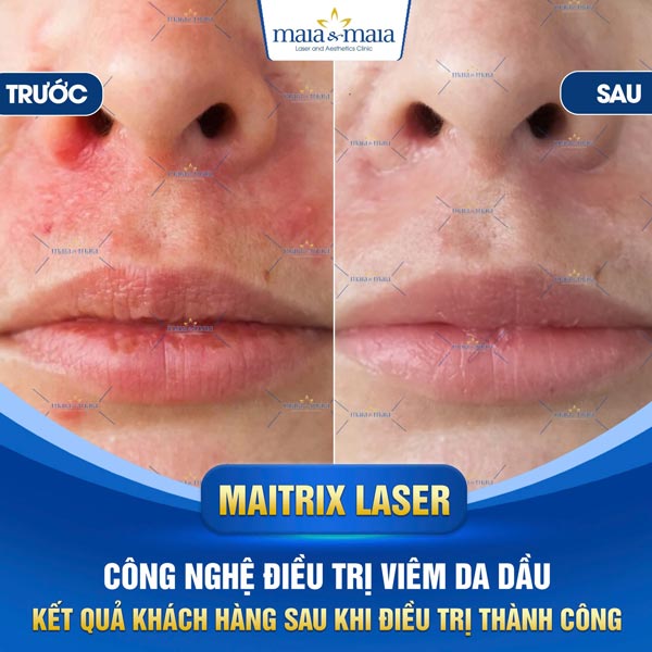 Viêm da dầu: Triệu chứng, chẩn đoán, điều trị và phòng ngừa 11 khách trị viêm da dầu