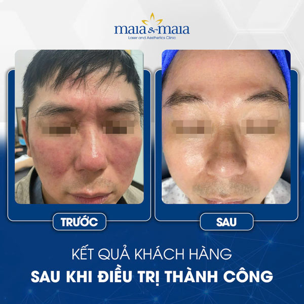 Viêm da dị ứng ở mặt có nguy hiểm không? Cách điều trị 10 khách trị viêm da mặt