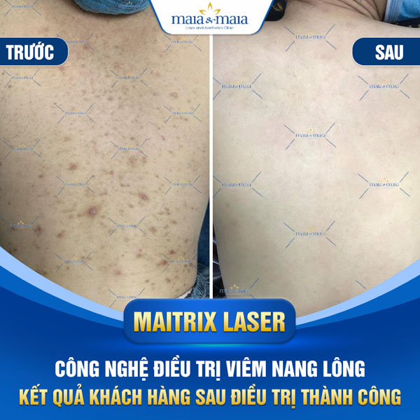 Viêm nang lông: Dấu hiệu, nguyên nhân và cách điều trị 11 khách trị viêm nang lông thành công