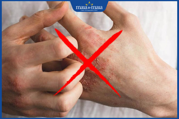 không gãi khi viêm da