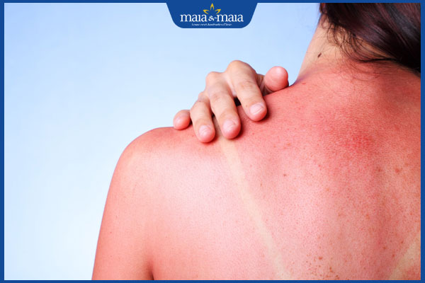 Viêm da do ánh nắng: Nguyên nhân, cách điều trị hiệu quả 2 làn da bị cháy nắng