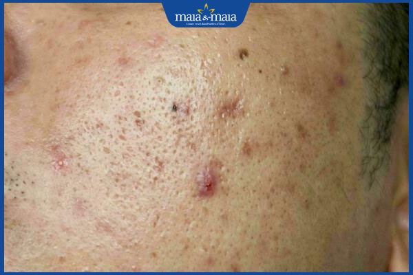 lỗ chân lông bị thâm viêm