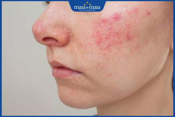 Viêm da dị ứng: Triệu chứng, nguyên nhân và cách điều trị 3 mặt viêm da dị ứng