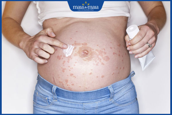 mẹ bầu bôi thuốc viêm da