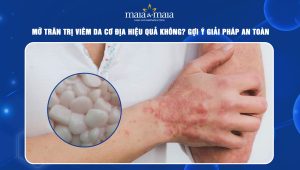 mỡ trăn trị viêm da cơ địa