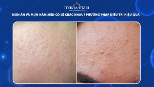 mụn ẩn và mụn nấm men