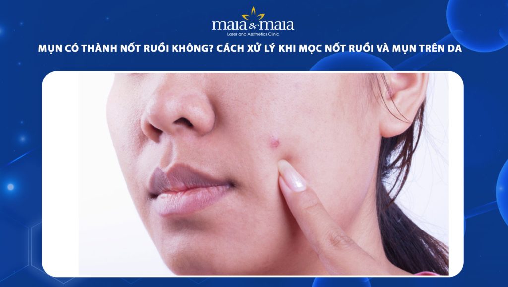 mụn có thành nốt ruồi không