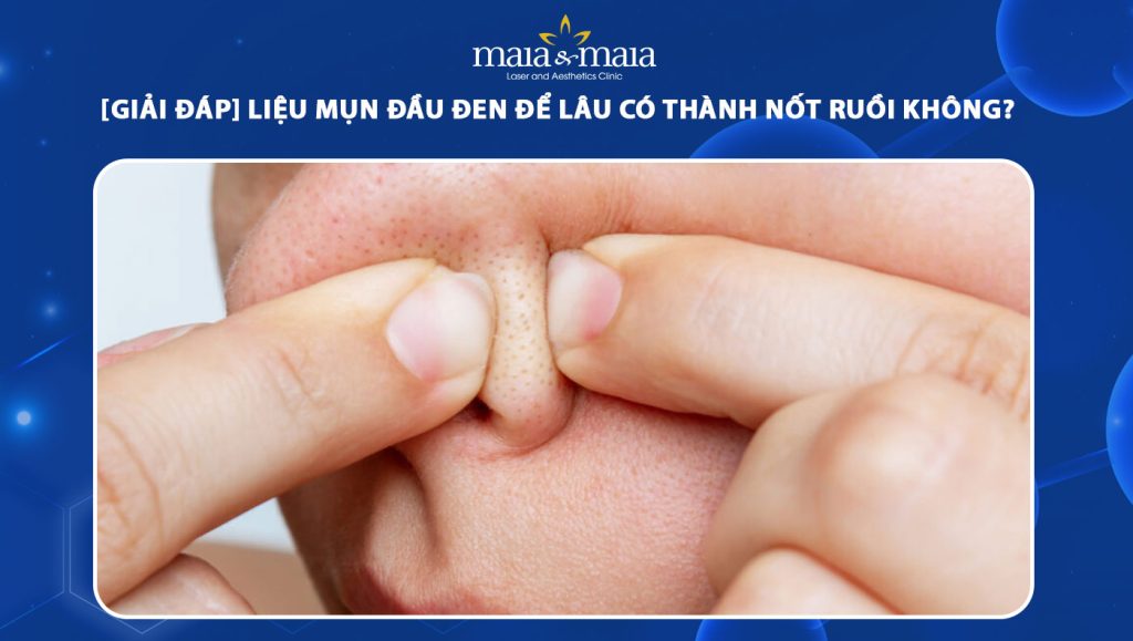 mụn đầu đen để lâu có thành nốt ruồi không