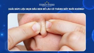 mụn đầu đen để lâu có thành nốt ruồi không