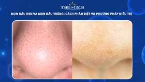 mụn đầu đen và mụn đầu trắng