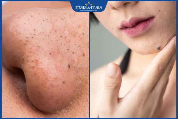 mụn đầu đen và nốt ruồi