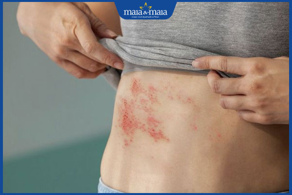 Ai dễ bị dị ứng thuốc kháng sinh? Cách nhận biết và xử lý 3 người bị hiv