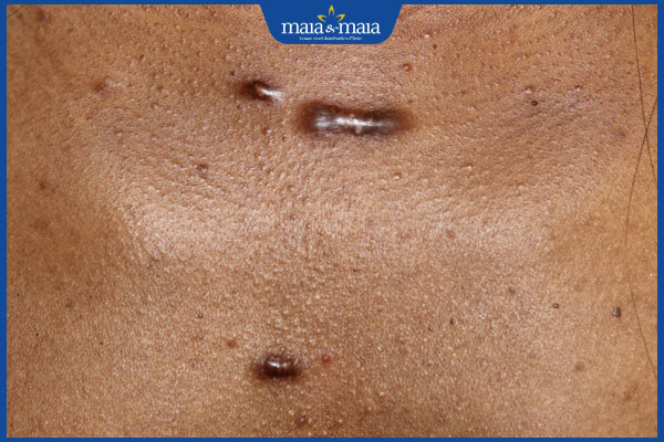 người dễ bị sẹo lồi ở ngực