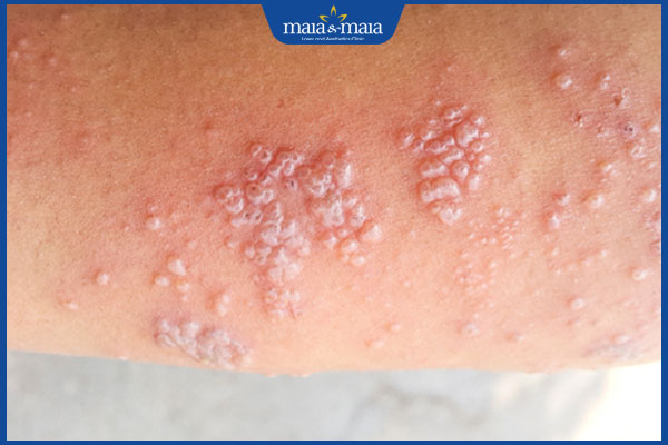 nguyên nhân gây viêm da dạng herpes