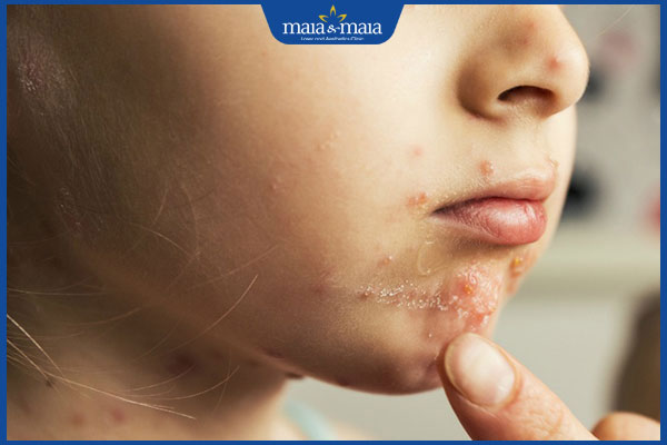 nguyên nhân gây viêm da mụn mủ