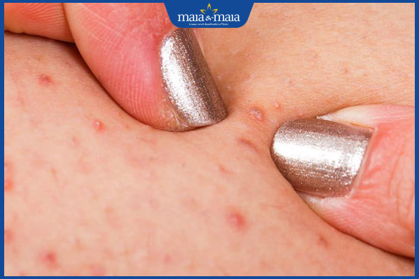 Viêm nang lông: Dấu hiệu, nguyên nhân và cách điều trị 7 nguyên nhân viêm nang lông