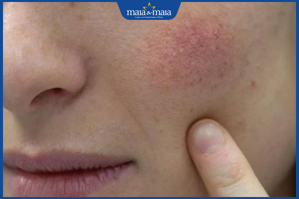 5 tips skincare cho viêm da tiết bã đúng cách 2 nguyên tắc chăm sóc viêm da tiết bã