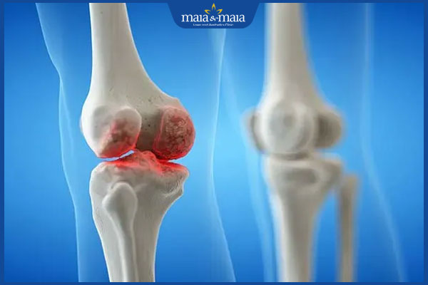 Bệnh viêm da tụ cầu do đâu? Cách điều trị như thế nào? 3 nhiễm khuẩn xương