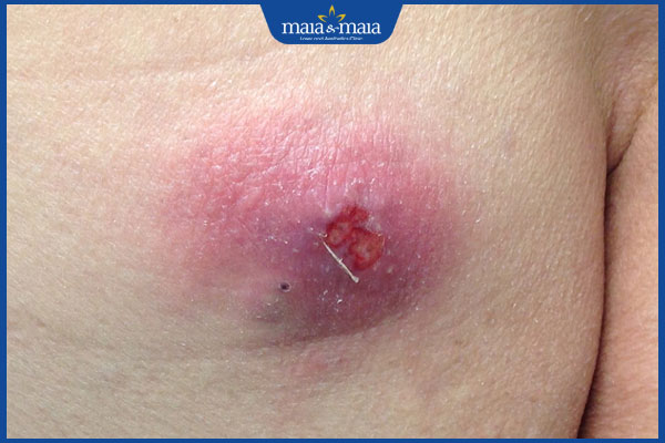 nhiễm trùng có mủ